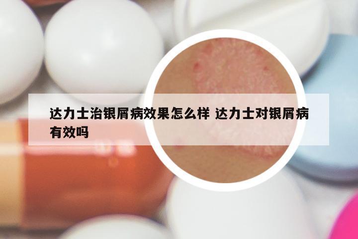 达力士治银屑病效果怎么样 达力士对银屑病有效吗