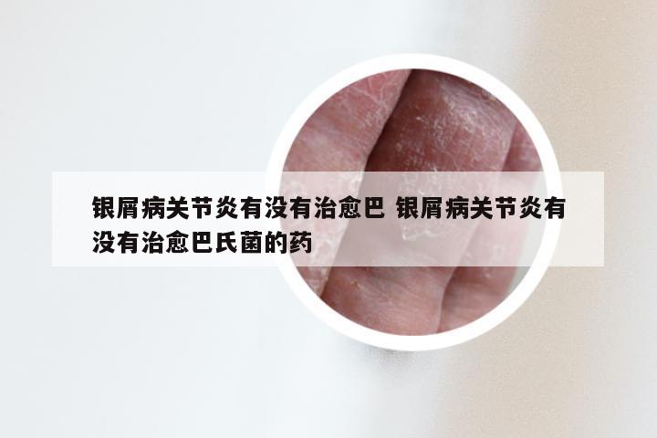 银屑病关节炎有没有治愈巴 银屑病关节炎有没有治愈巴氏菌的药