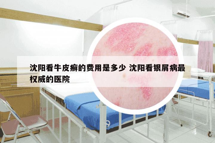 沈阳看牛皮癣的费用是多少 沈阳看银屑病最权威的医院
