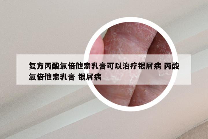 复方丙酸氯倍他索乳膏可以治疗银屑病 丙酸氯倍他索乳膏 银屑病