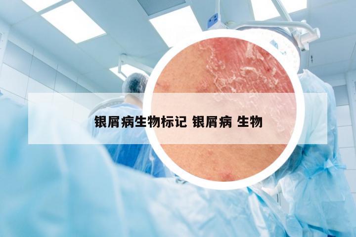 银屑病生物标记 银屑病 生物