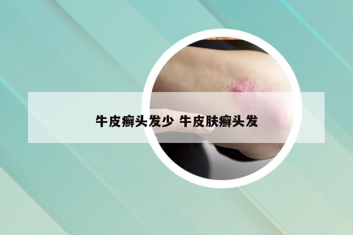 牛皮癣头发少 牛皮肤癣头发
