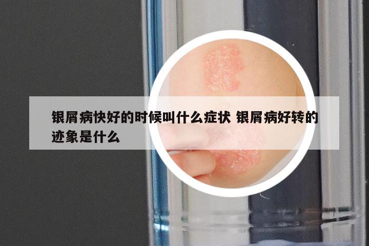 银屑病快好的时候叫什么症状 银屑病好转的迹象是什么