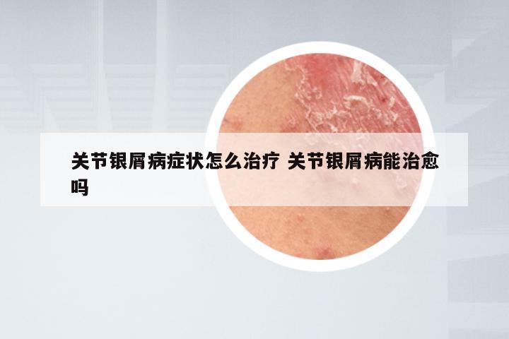 关节银屑病症状怎么治疗 关节银屑病能治愈吗