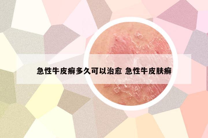 急性牛皮癣多久可以治愈 急性牛皮肤癣