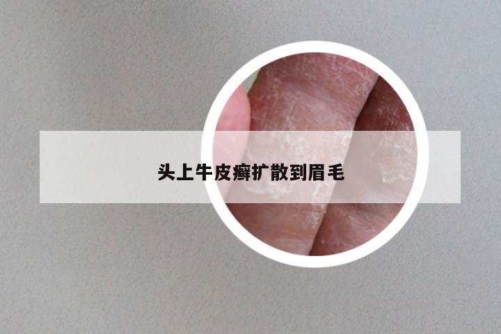 头上牛皮癣扩散到眉毛
