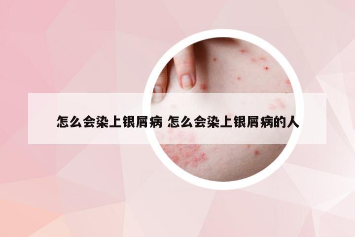 怎么会染上银屑病 怎么会染上银屑病的人