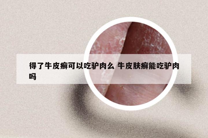 得了牛皮癣可以吃驴肉么 牛皮肤癣能吃驴肉吗