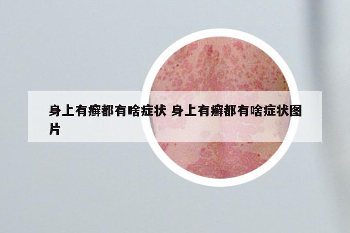 身上有癣都有啥症状 身上有癣都有啥症状图片