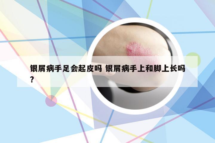 银屑病手足会起皮吗 银屑病手上和脚上长吗?