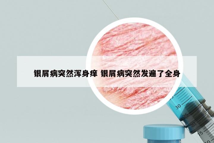 银屑病突然浑身痒 银屑病突然发遍了全身