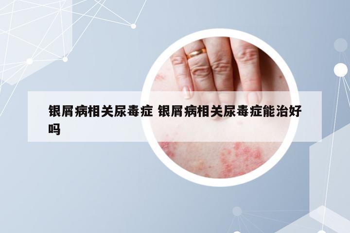 银屑病相关尿毒症 银屑病相关尿毒症能治好吗
