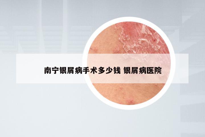 南宁银屑病手术多少钱 银屑病医院