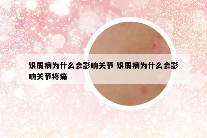 银屑病为什么会影响关节 银屑病为什么会影响关节疼痛