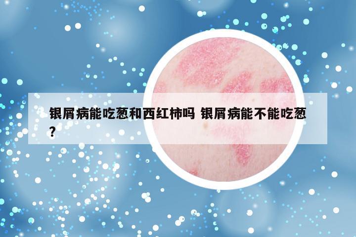 银屑病能吃葱和西红柿吗 银屑病能不能吃葱?