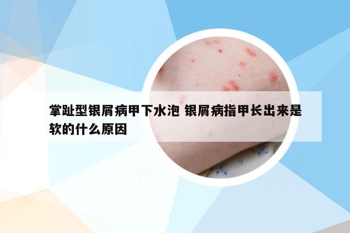 掌趾型银屑病甲下水泡 银屑病指甲长出来是软的什么原因