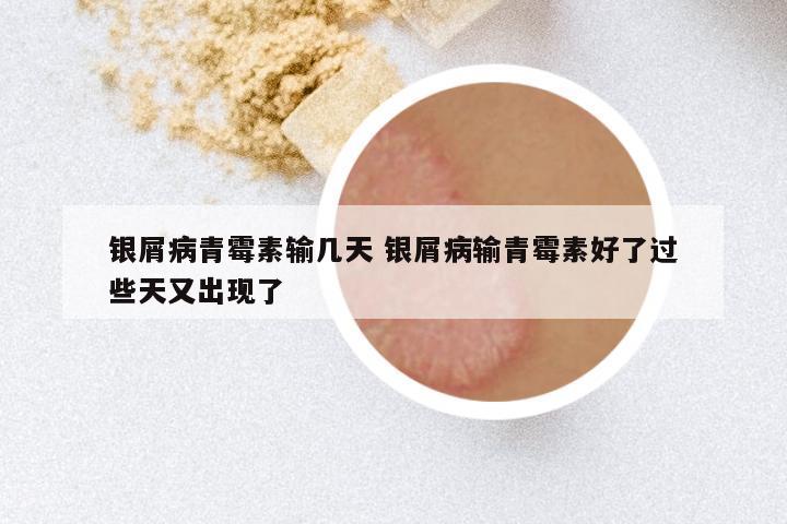 银屑病青霉素输几天 银屑病输青霉素好了过些天又出现了