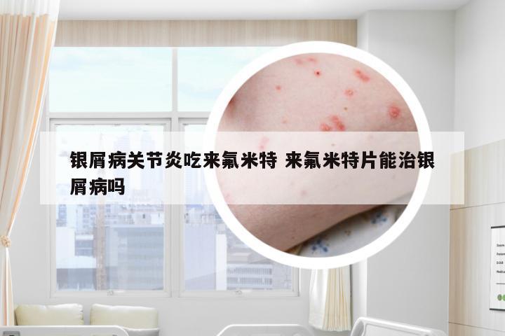银屑病关节炎吃来氟米特 来氟米特片能治银屑病吗