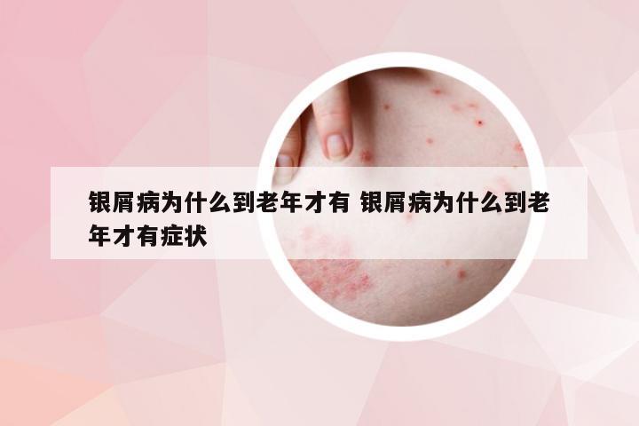 银屑病为什么到老年才有 银屑病为什么到老年才有症状