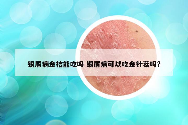 银屑病金桔能吃吗 银屑病可以吃金针菇吗?