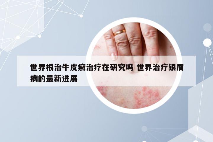 世界根治牛皮癣治疗在研究吗 世界治疗银屑病的最新进展