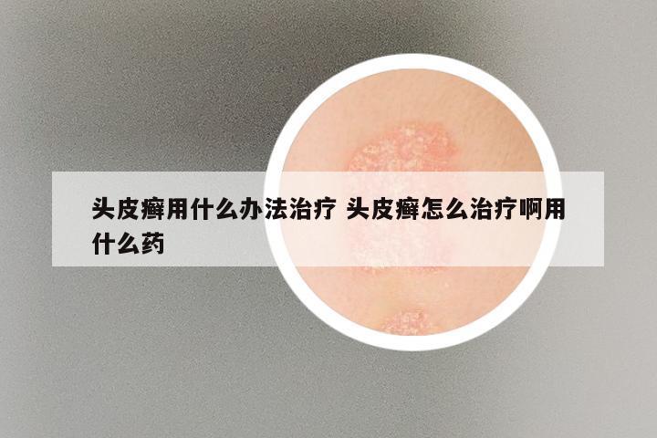 头皮癣用什么办法治疗 头皮癣怎么治疗啊用什么药