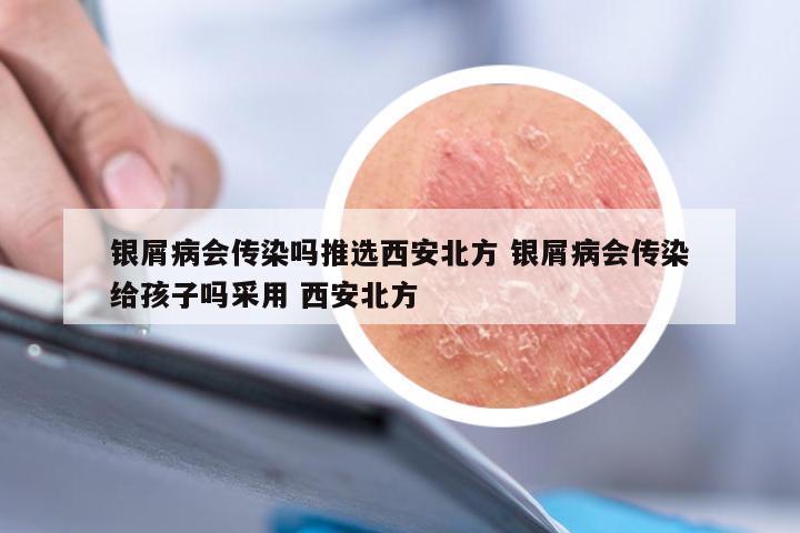 银屑病会传染吗推选西安北方 银屑病会传染给孩子吗采用 西安北方