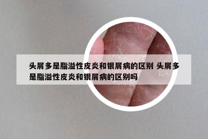 头屑多是脂溢性皮炎和银屑病的区别 头屑多是脂溢性皮炎和银屑病的区别吗