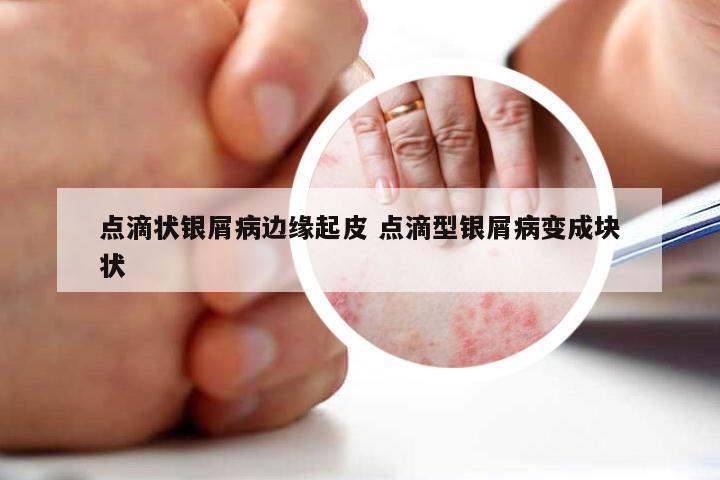 点滴状银屑病边缘起皮 点滴型银屑病变成块状