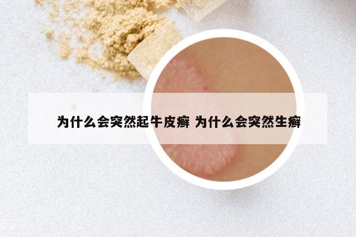 为什么会突然起牛皮癣 为什么会突然生癣