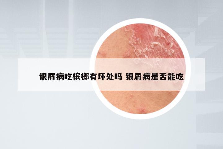 银屑病吃槟榔有坏处吗 银屑病是否能吃