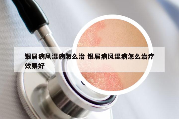 银屑病风湿病怎么治 银屑病风湿病怎么治疗效果好