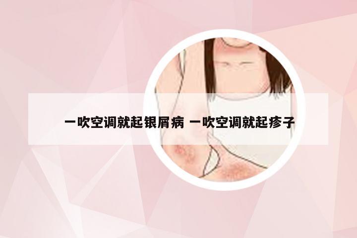 一吹空调就起银屑病 一吹空调就起疹子