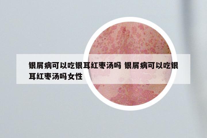 银屑病可以吃银耳红枣汤吗 银屑病可以吃银耳红枣汤吗女性