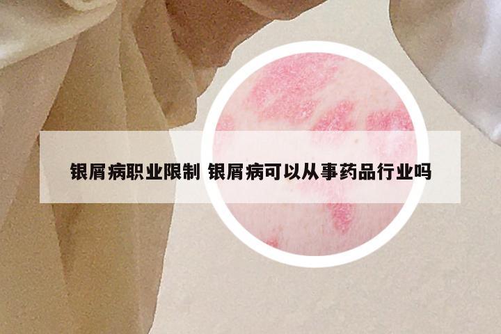 银屑病职业限制 银屑病可以从事药品行业吗