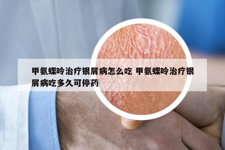 甲氨蝶呤治疗银屑病怎么吃 甲氨蝶呤治疗银屑病吃多久可停药