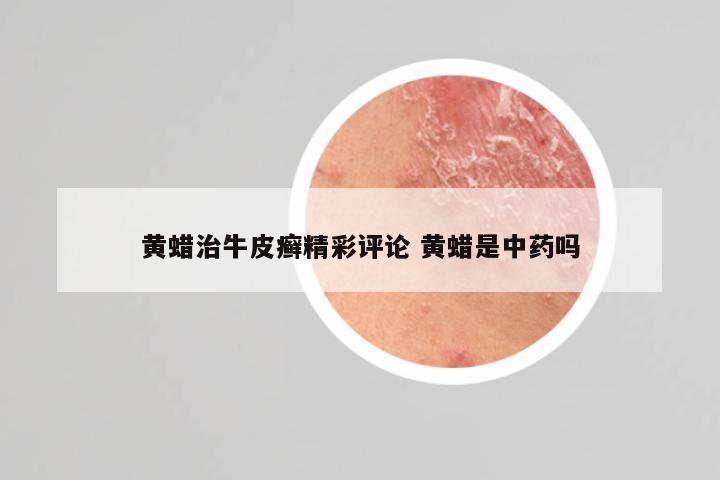 黄蜡治牛皮癣精彩评论 黄蜡是中药吗