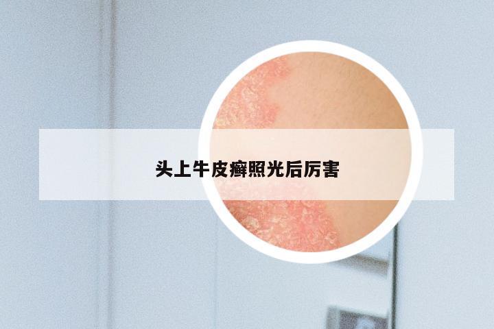 头上牛皮癣照光后厉害