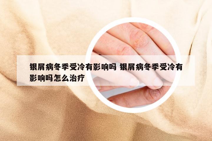 银屑病冬季受冷有影响吗 银屑病冬季受冷有影响吗怎么治疗