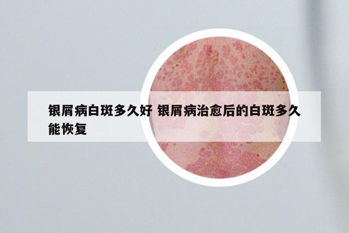 银屑病白斑多久好 银屑病治愈后的白斑多久能恢复