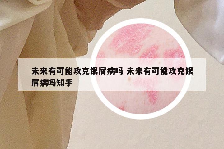 未来有可能攻克银屑病吗 未来有可能攻克银屑病吗知乎