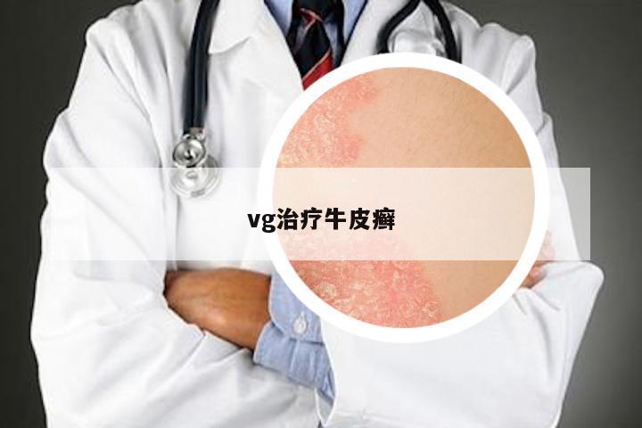 vg治疗牛皮癣