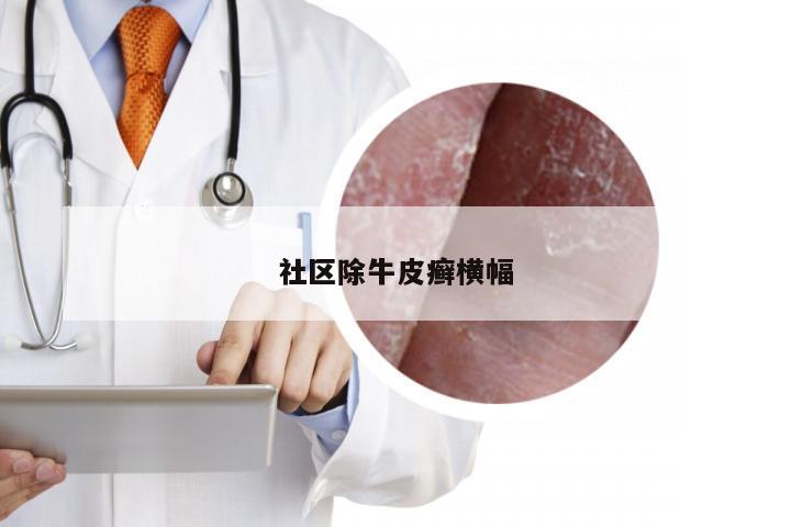 社区除牛皮癣横幅