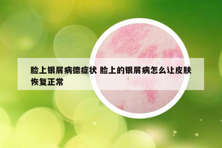 脸上银屑病德症状 脸上的银屑病怎么让皮肤恢复正常
