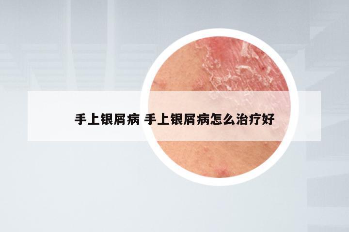 手上银屑病 手上银屑病怎么治疗好