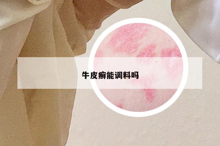牛皮癣能调料吗
