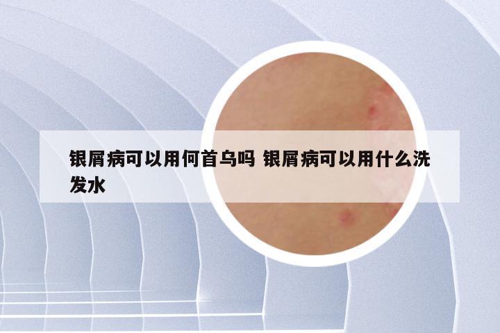 银屑病可以用何首乌吗 银屑病可以用什么洗发水