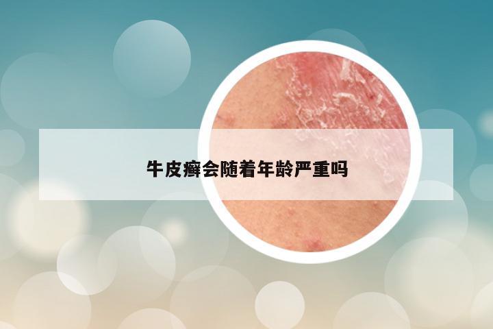 牛皮癣会随着年龄严重吗