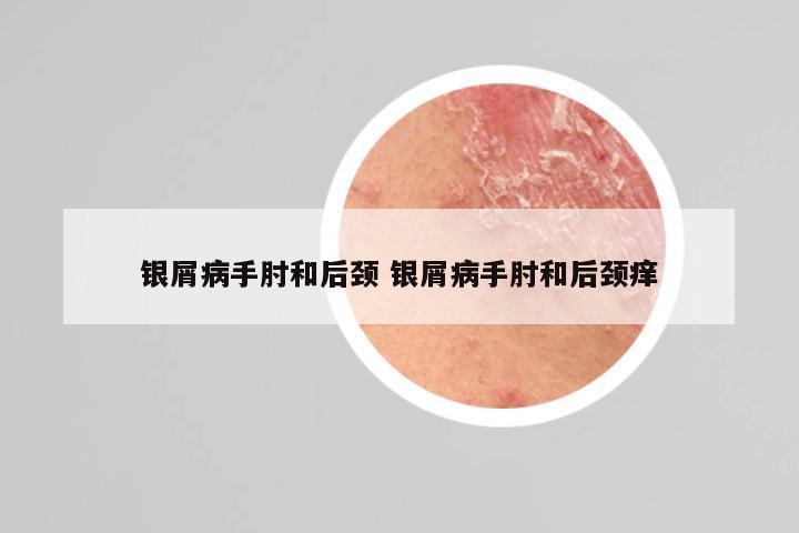 银屑病手肘和后颈 银屑病手肘和后颈痒