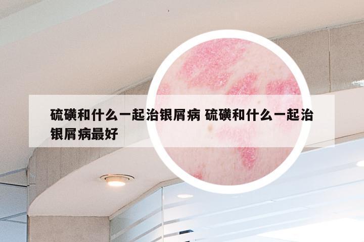 硫磺和什么一起治银屑病 硫磺和什么一起治银屑病最好